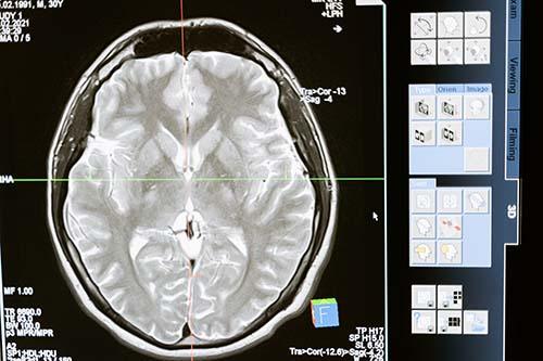 Transformative Potential of Hyperbaric Oxygen Therapy for Traumatic Brain Injury