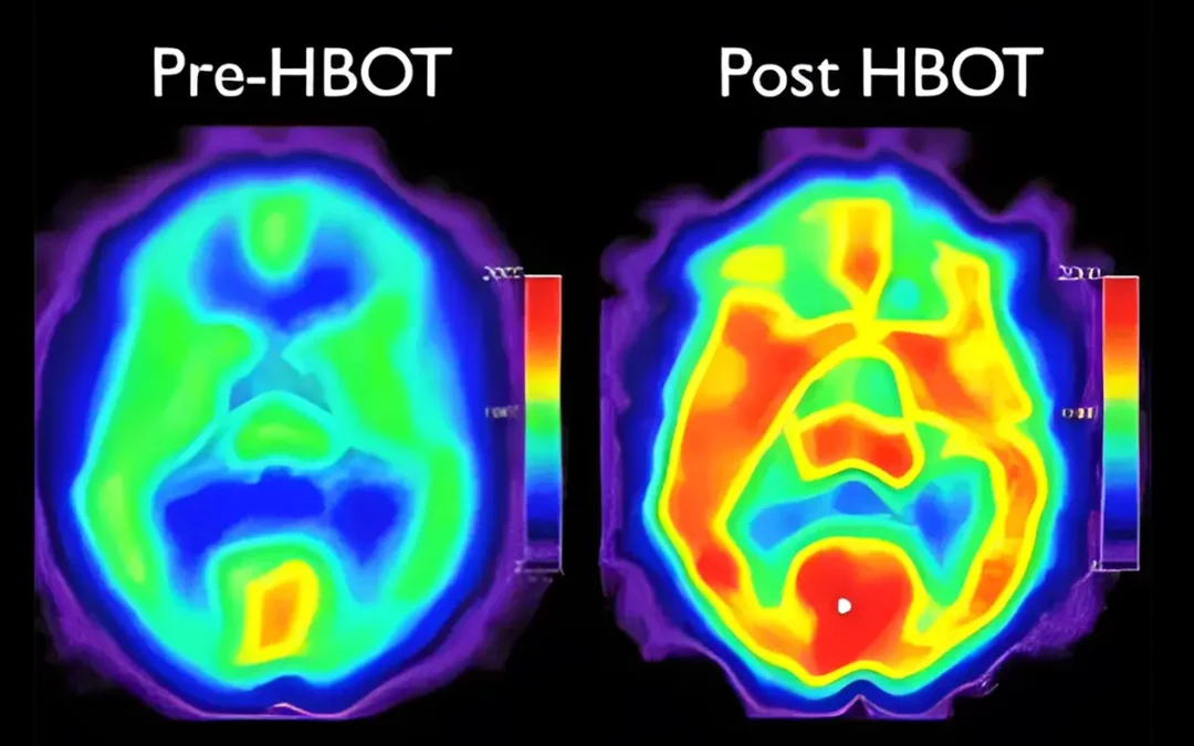 Do I have to use an oxygen concentrator with my MHBOT to see results