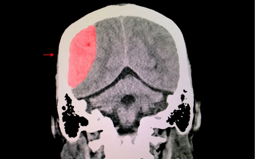 TBI & Brain Injury Recoveries Thanks to Dr. Harch and HBOT