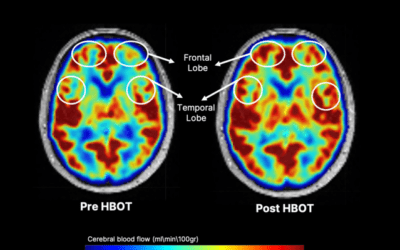 New Hyperbaric Therapy Could Limit and Perhaps Reverse Cognitive Decline