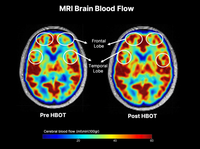 New Hyperbaric Therapy Could Limit and Perhaps Reverse Cognitive Decline