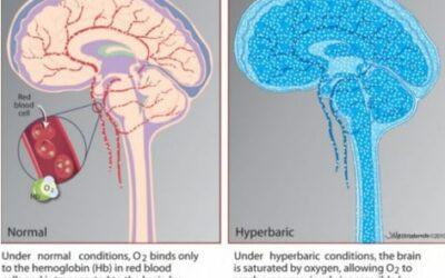 Mild Hyperbaric Oxygen Therapy